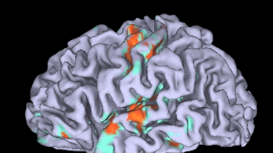Un chip nel cervello aiuta i malati di Parkinson a camminare