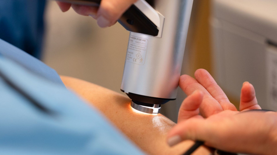 Migliora la prognosi per il melanoma cutaneo, pi&ugrave; pazienti guariti in fase precoce